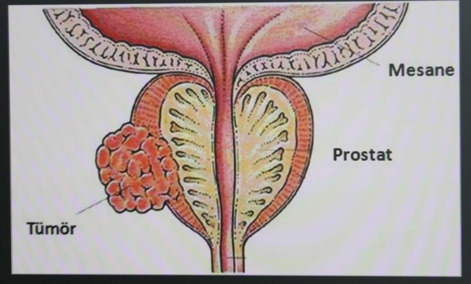 prostat kanseri nedir ve belirtileri nelerdir?